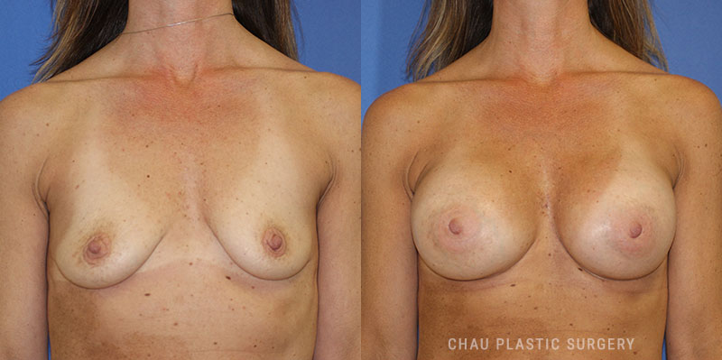 Subfascial Breast Augmentation Before and After Photo. Surgery performed in Detroit, MI at Chau Plastic Surgery.