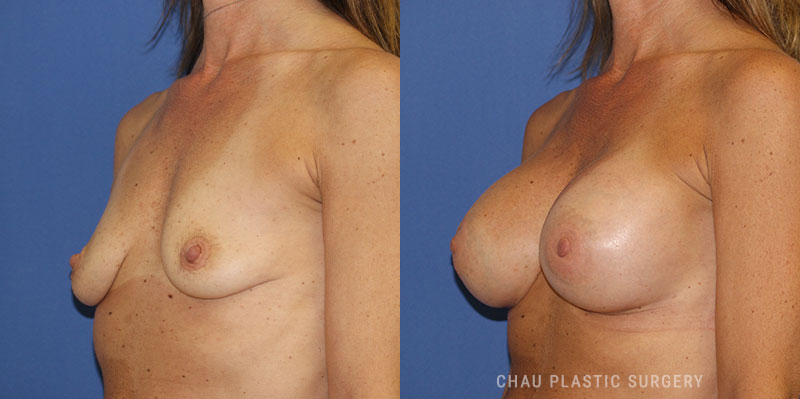 Subfascial Breast Augmentation Before and After Photo. Surgery performed in Detroit, MI at Chau Plastic Surgery.
