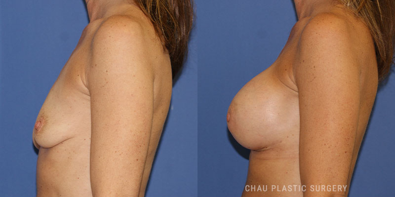 Subfascial Breast Augmentation Before and After Photo. Surgery performed in Detroit, MI at Chau Plastic Surgery.