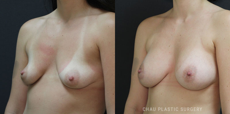 Subfascial Breast Augmentation Before and After Photo. Surgery performed in Detroit, MI at Chau Plastic Surgery.