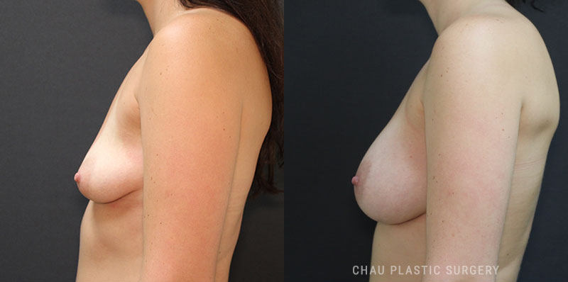Subfascial Breast Augmentation Before and After Photo. Surgery performed in Detroit, MI at Chau Plastic Surgery.
