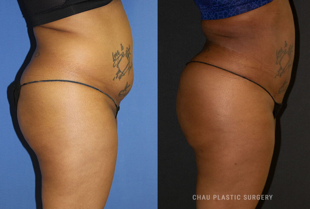 BBL (Brazilian Butt Lift) Before & After Photo. BBL performed at Chau Plastic Surgery in Metro Detroit, MI.