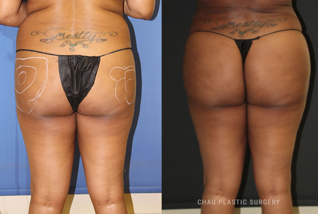 BBL (Brazilian Butt Lift) Before & After Photo. BBL performed at Chau Plastic Surgery in Metro Detroit, MI.