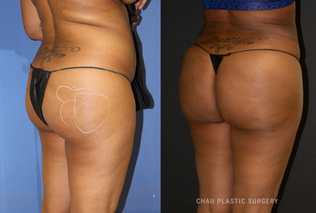 BBL (Brazilian Butt Lift) Before & After Photo. BBL performed at Chau Plastic Surgery in Metro Detroit, MI.