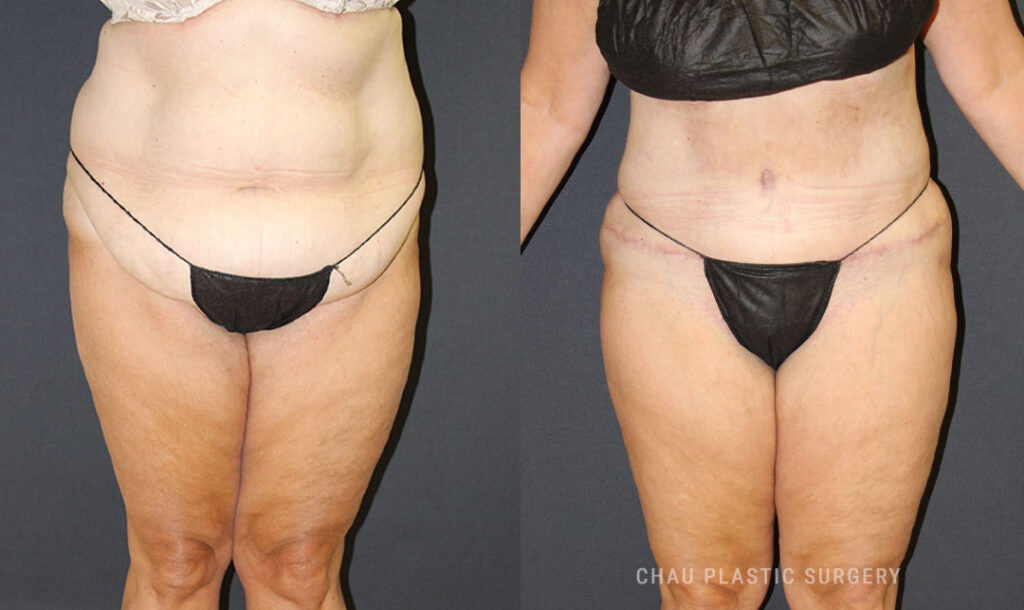 Liposuction Before & After Photo. Liposuction performed at Chau Plastic Surgery in Metro Detroit, MI.