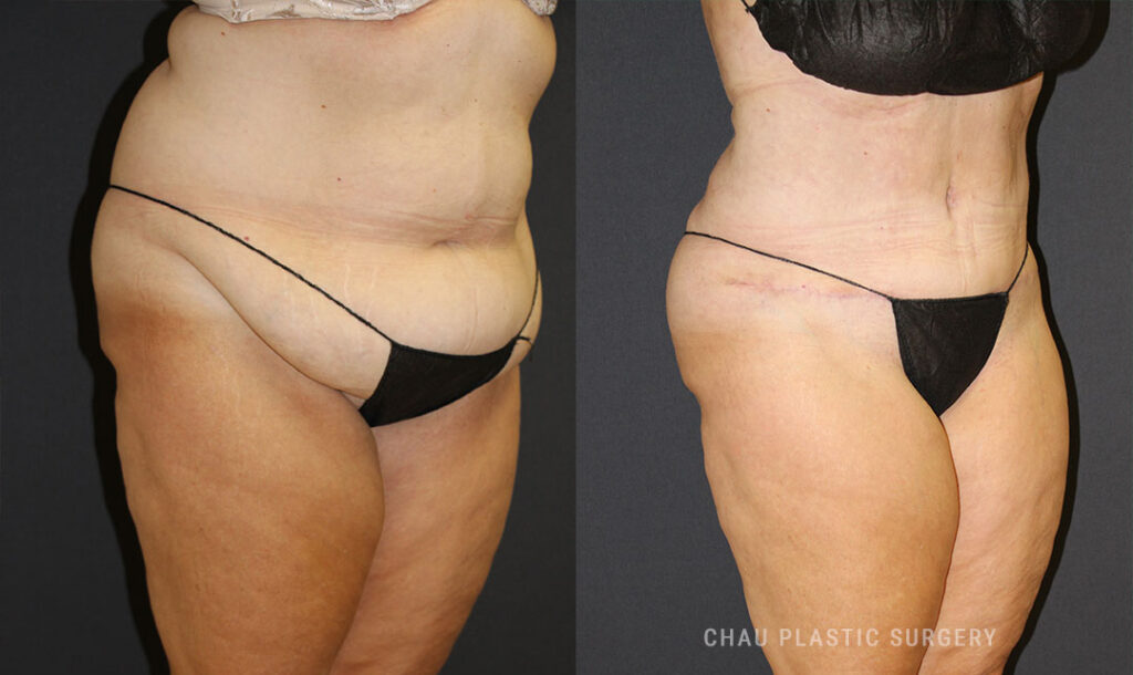 Liposuction Before & After Photo. Liposuction performed at Chau Plastic Surgery in Metro Detroit, MI.
