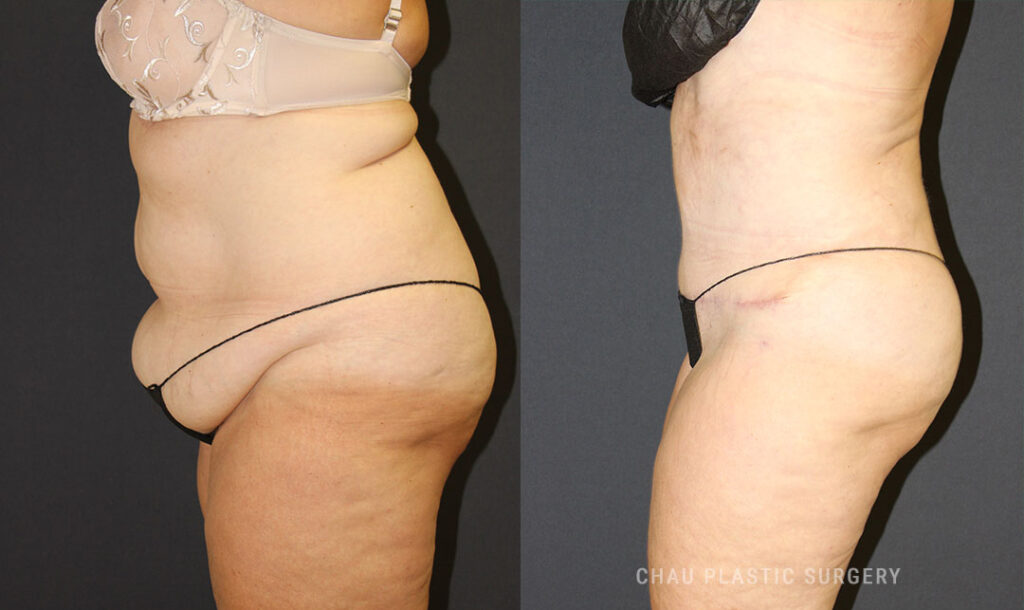 Liposuction Before & After Photo. Liposuction performed at Chau Plastic Surgery in Metro Detroit, MI.