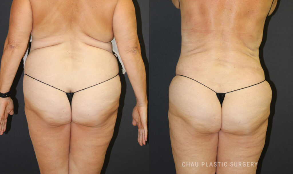 Liposuction Before & After Photo. Liposuction performed at Chau Plastic Surgery in Metro Detroit, MI.