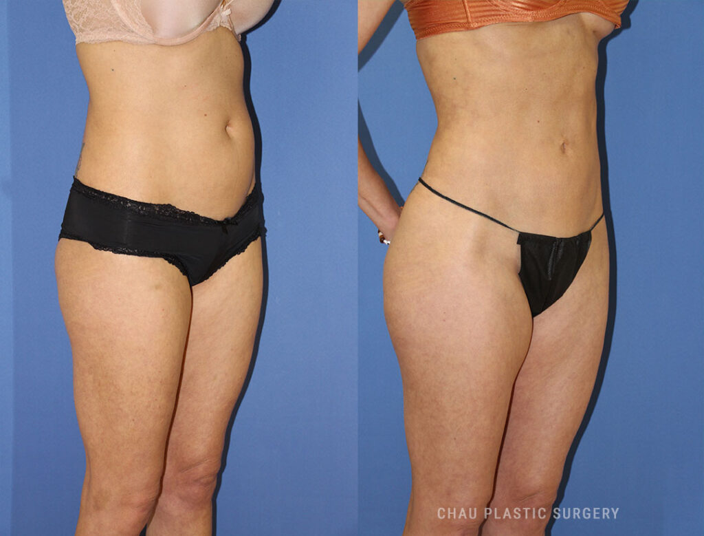 Liposuction Before & After Photo. Liposuction performed at Chau Plastic Surgery in Metro Detroit, MI.