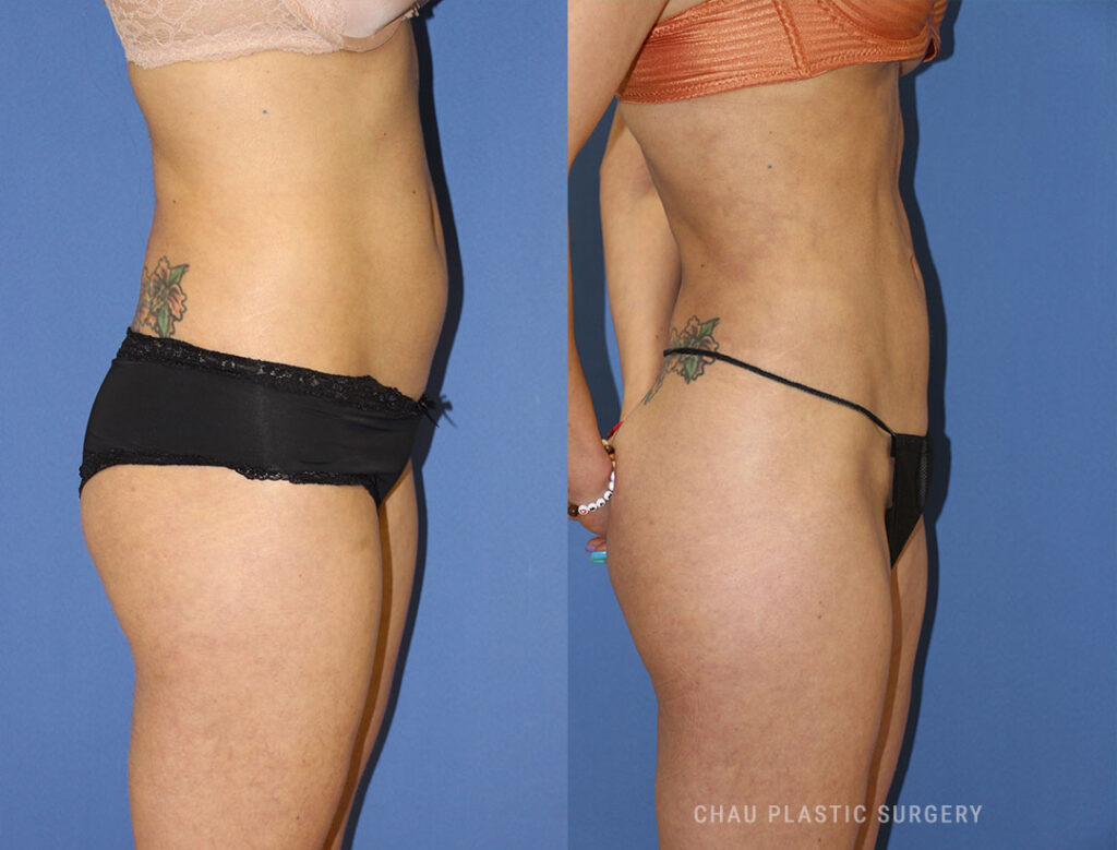 Liposuction Before & After Photo. Liposuction performed at Chau Plastic Surgery in Metro Detroit, MI.