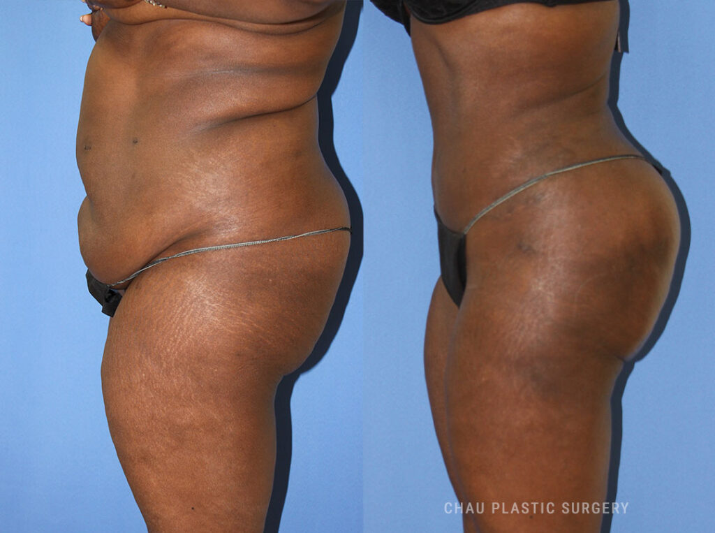 Liposuction Before & After Photo. Liposuction performed at Chau Plastic Surgery in Metro Detroit, MI.