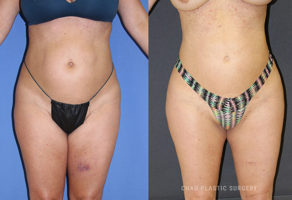 Liposuction Before & After Photo. Liposuction performed at Chau Plastic Surgery in Metro Detroit, MI.