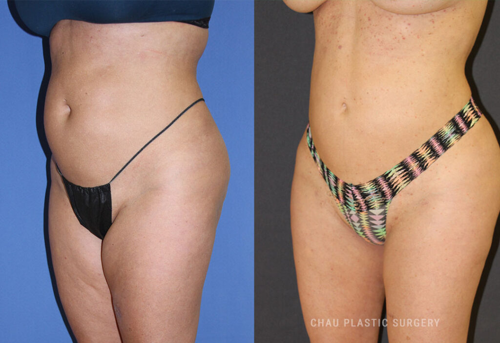 Liposuction Before & After Photo. Liposuction performed at Chau Plastic Surgery in Metro Detroit, MI.