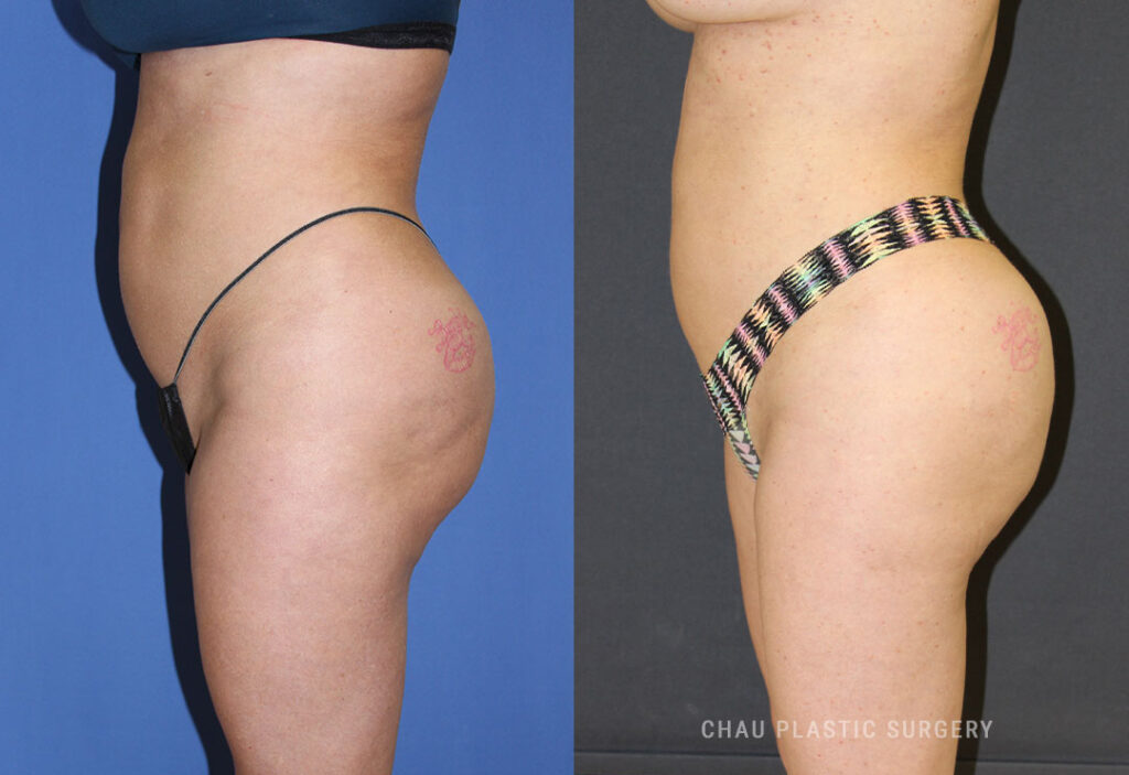 Liposuction Before & After Photo. Liposuction performed at Chau Plastic Surgery in Metro Detroit, MI.