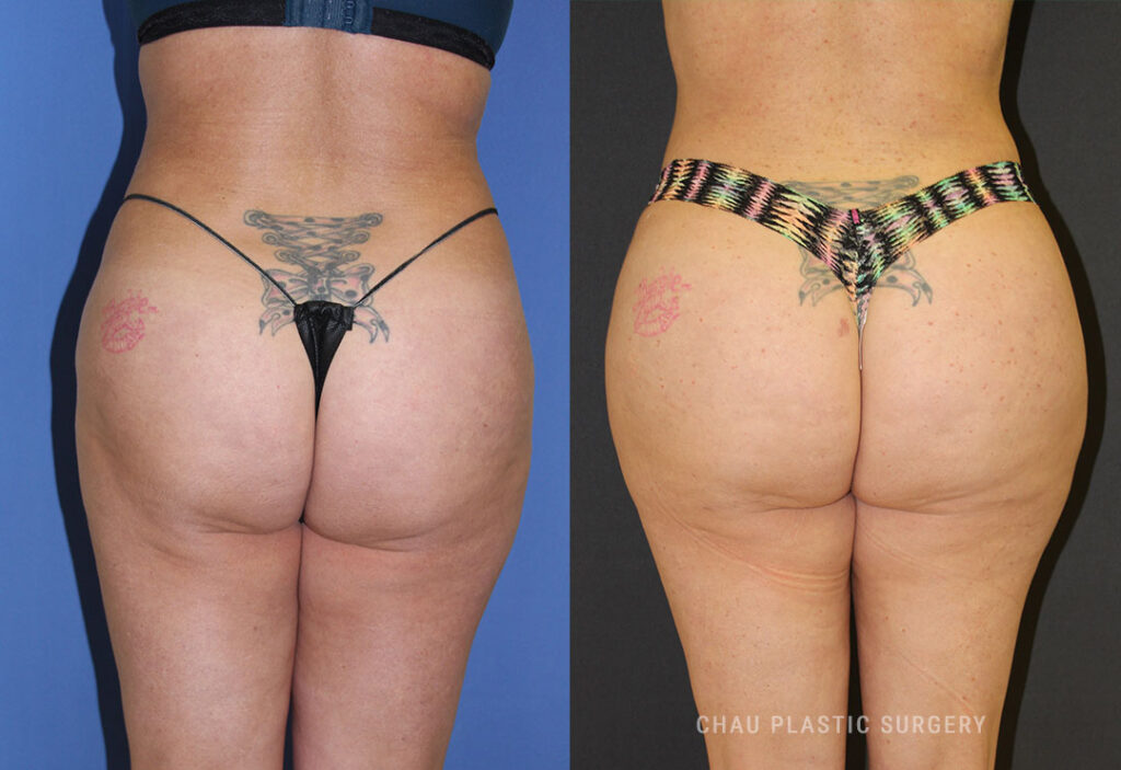 Liposuction Before & After Photo. Liposuction performed at Chau Plastic Surgery in Metro Detroit, MI.