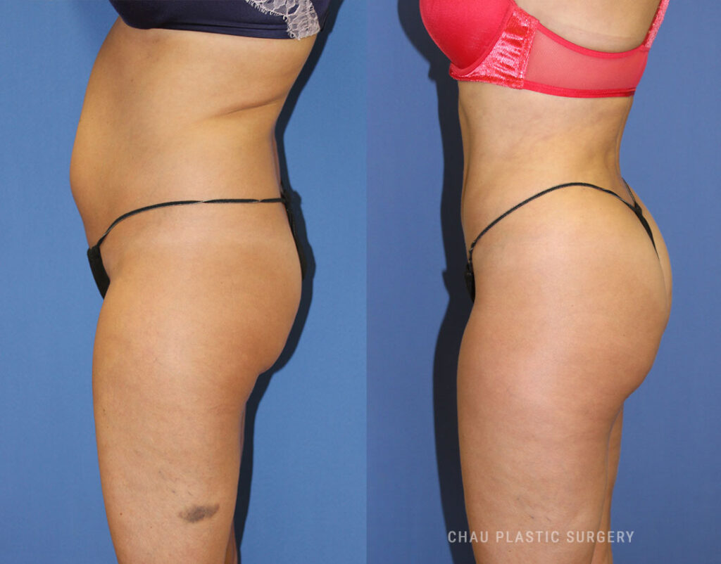 Liposuction Before & After Photo. Liposuction performed at Chau Plastic Surgery in Metro Detroit, MI.