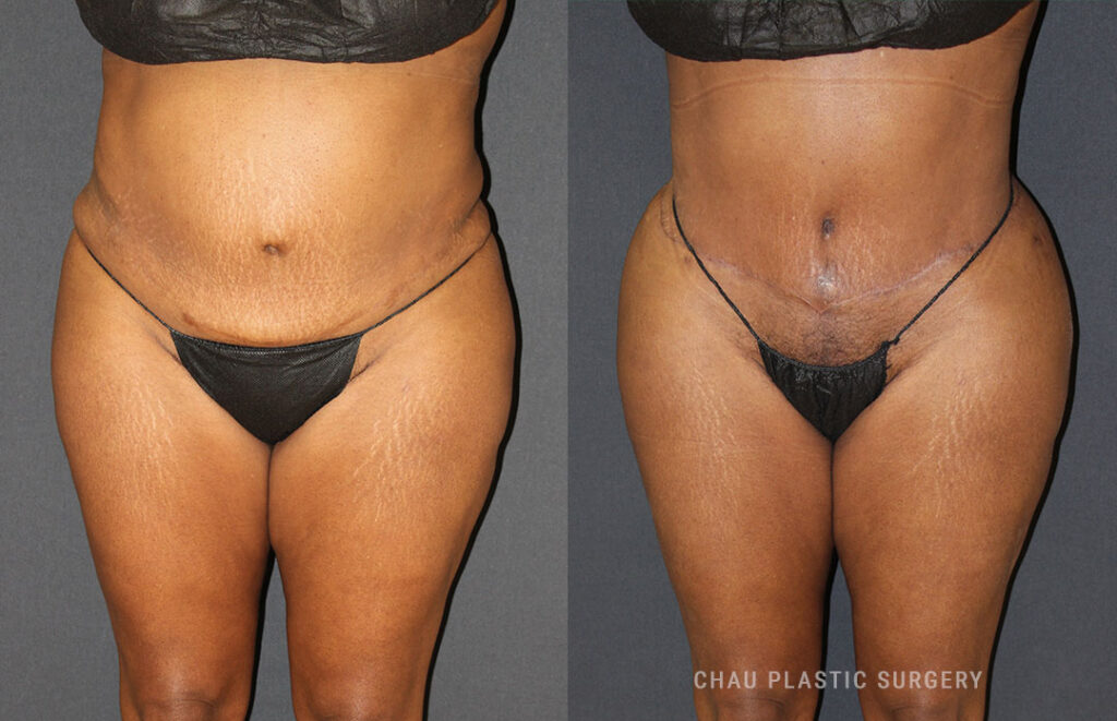 Liposuction Before & After Photo. Liposuction performed at Chau Plastic Surgery in Metro Detroit, MI.