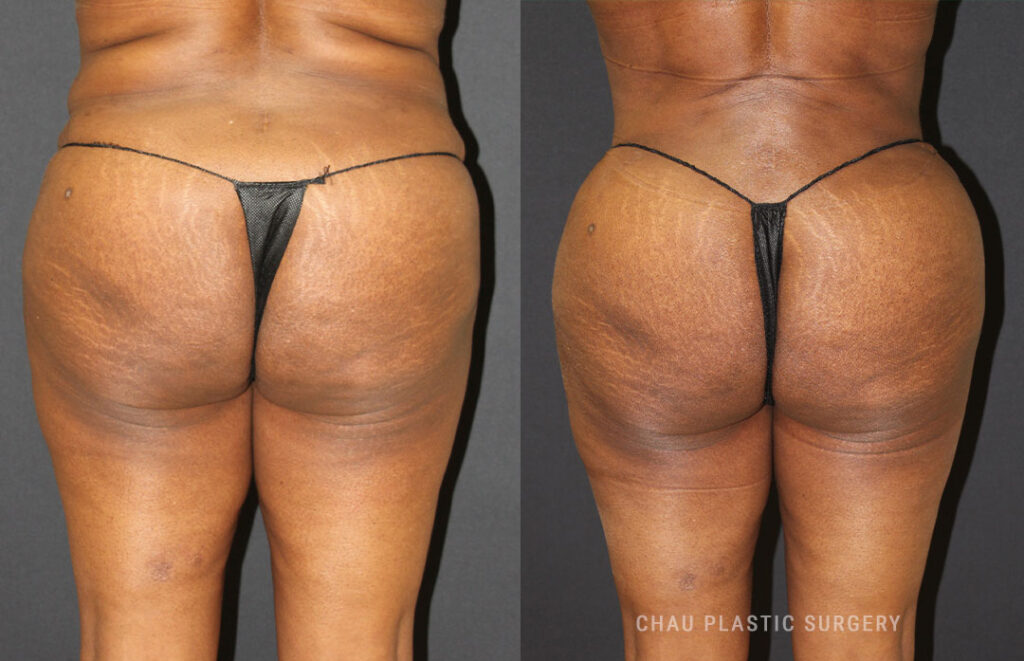 Liposuction Before & After Photo. Liposuction performed at Chau Plastic Surgery in Metro Detroit, MI.