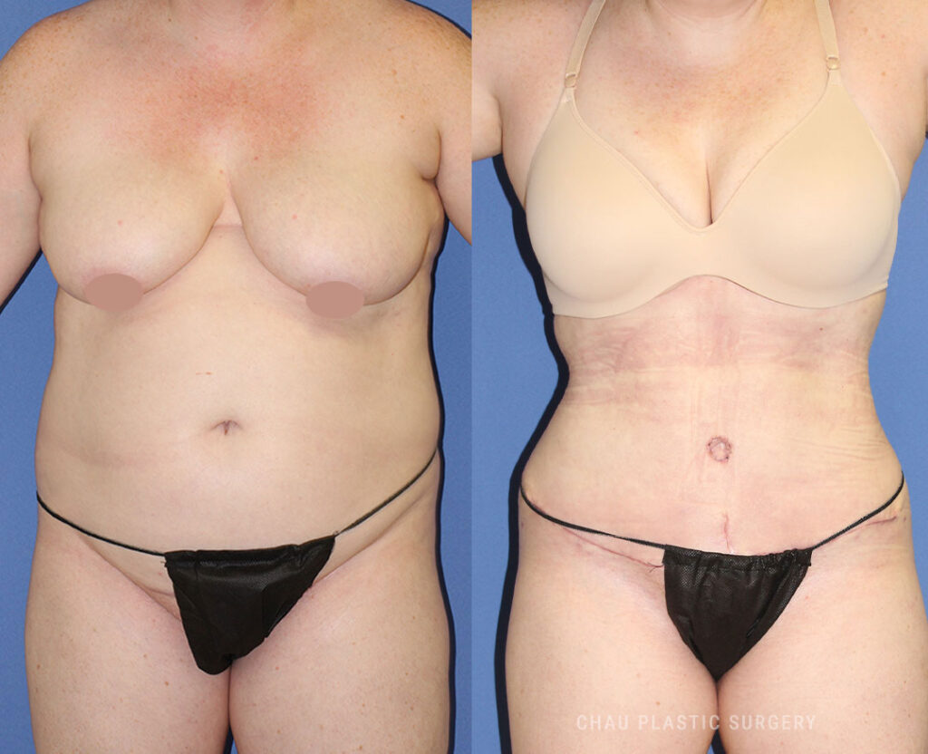 Liposuction Before & After Photo. Liposuction performed at Chau Plastic Surgery in Metro Detroit, MI.