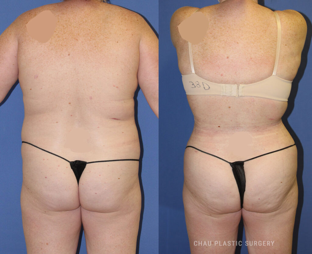 Liposuction Before & After Photo. Liposuction performed at Chau Plastic Surgery in Metro Detroit, MI.