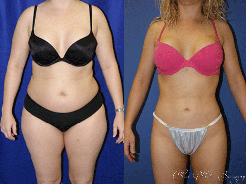 Liposuction Before & After Photo. Surgery performed at Chau Plastic Surgery in Metro Detroit, MI.