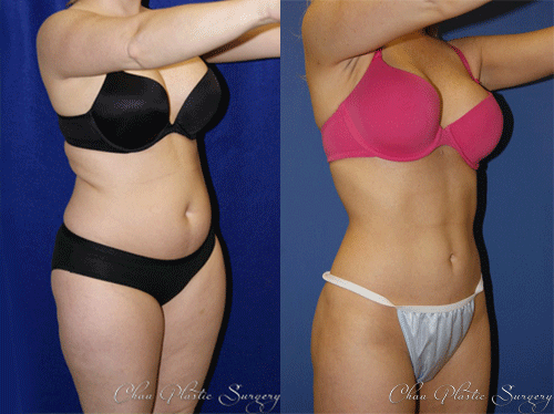 Liposuction Before & After Photo. Surgery performed at Chau Plastic Surgery in Metro Detroit, MI.
