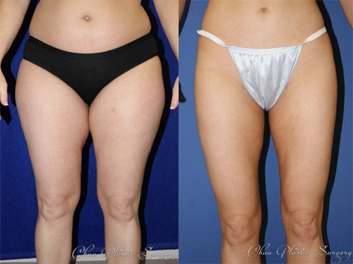 Liposuction Before & After Photo. Surgery performed at Chau Plastic Surgery in Metro Detroit, MI.
