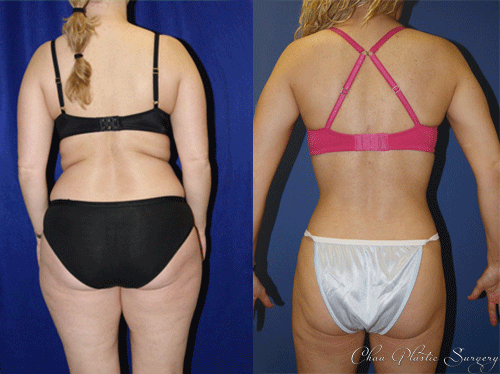 Liposuction Before & After Photo. Surgery performed at Chau Plastic Surgery in Metro Detroit, MI.