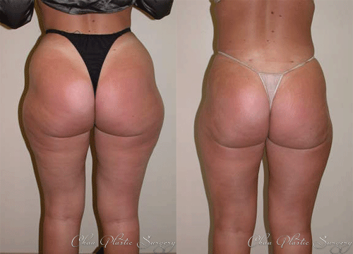 Liposuction Before & After Photo. Surgery performed at Chau Plastic Surgery in Metro Detroit, MI.