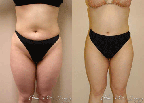 Liposuction Before & After Photo. Surgery performed at Chau Plastic Surgery in Metro Detroit, MI.