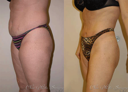 Liposuction Before & After Photo. Surgery performed at Chau Plastic Surgery in Metro Detroit, MI.