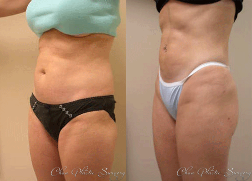 Liposuction Before & After Photo. Surgery performed at Chau Plastic Surgery in Metro Detroit, MI.