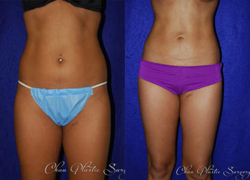 Liposuction Before & After Photo. Surgery performed at Chau Plastic Surgery in Metro Detroit, MI.