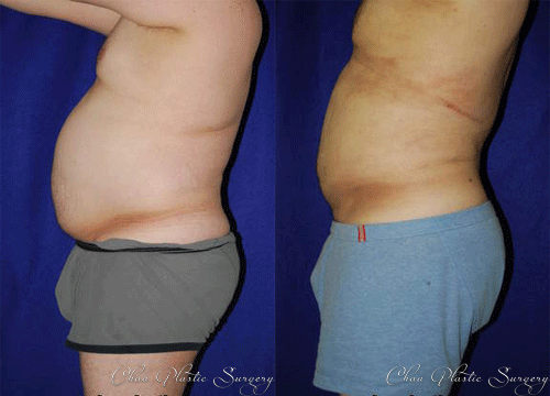Liposuction Before & After Photo. Surgery performed at Chau Plastic Surgery in Metro Detroit, MI.