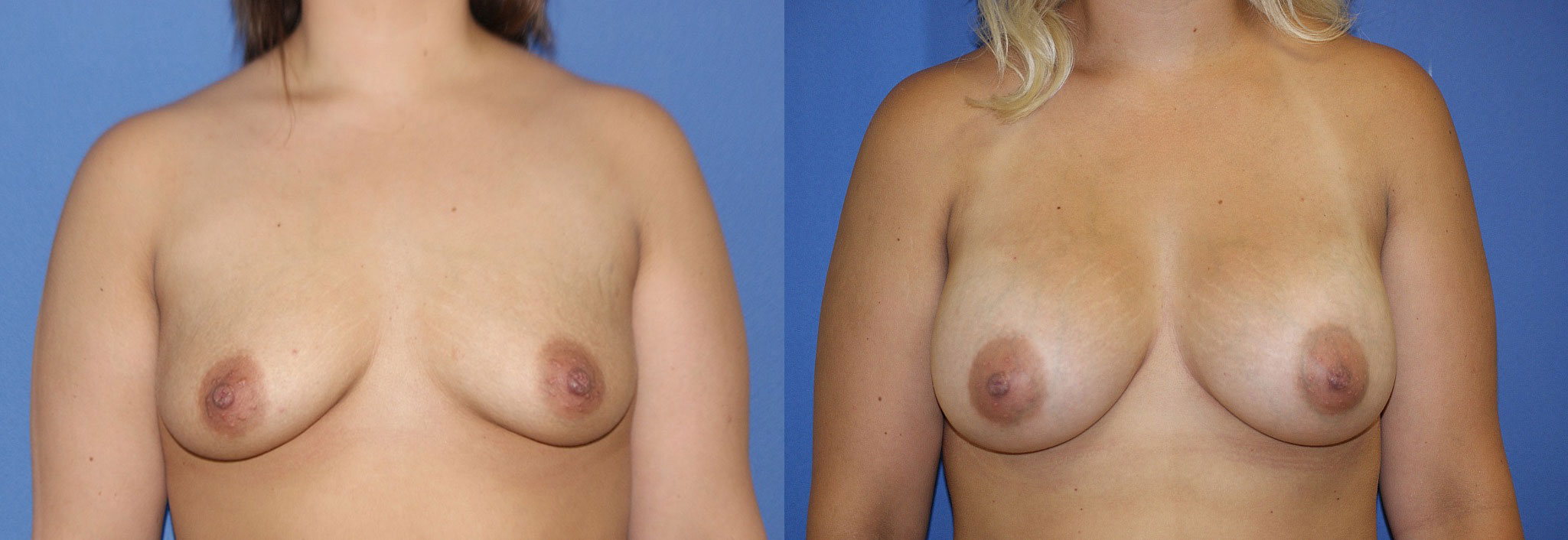 Breast Augmentation Before & After Photo. Breast Augmentation performed at Chau Plastic Surgery in Metro Detroit, MI.