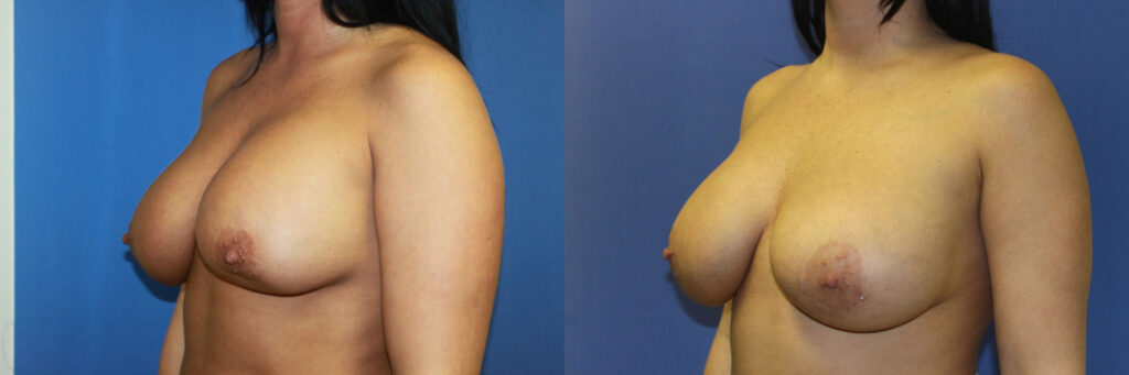 Breast Augmentation Before & After Photo. Breast Augmentation performed at Chau Plastic Surgery in Metro Detroit, MI.