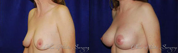Breast Augmentation Before & After Photo. Breast Augmentation performed at Chau Plastic Surgery in Metro Detroit, MI.