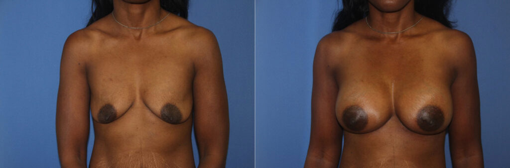 Breast Augmentation Before & After Photo. Breast Augmentation performed at Chau Plastic Surgery in Metro Detroit, MI.