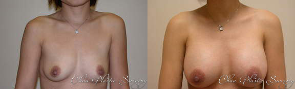Breast Augmentation Before & After Photo. Breast Augmentation performed at Chau Plastic Surgery in Metro Detroit, MI.
