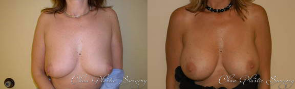 Breast Augmentation Before & After Photo. Breast Augmentation performed at Chau Plastic Surgery in Metro Detroit, MI.