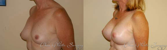 Breast Augmentation Before & After Photo. Breast Augmentation performed at Chau Plastic Surgery in Metro Detroit, MI.