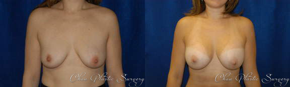 Breast Augmentation Before & After Photo. Breast Augmentation performed at Chau Plastic Surgery in Metro Detroit, MI.
