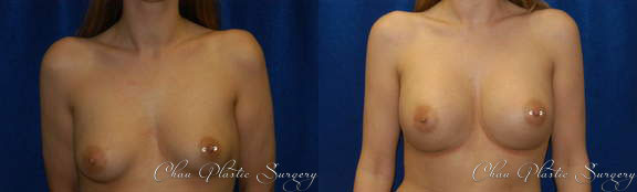 Breast Augmentation Before & After Photo. Breast Augmentation performed at Chau Plastic Surgery in Metro Detroit, MI.