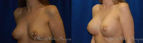 Breast Augmentation Before & After Photo. Breast Augmentation performed at Chau Plastic Surgery in Metro Detroit, MI.