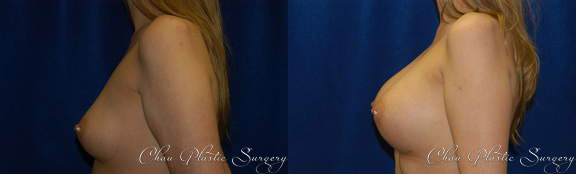Breast Augmentation Before & After Photo. Breast Augmentation performed at Chau Plastic Surgery in Metro Detroit, MI.