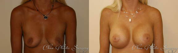 Breast Augmentation Before & After Photo. Breast Augmentation performed at Chau Plastic Surgery in Metro Detroit, MI.