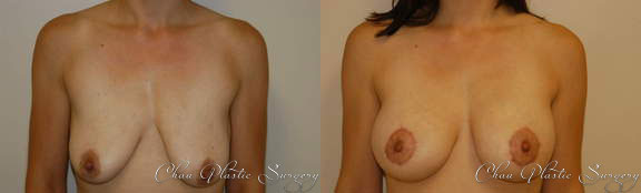 Breast Augmentation Before & After Photo. Breast Augmentation performed at Chau Plastic Surgery in Metro Detroit, MI.