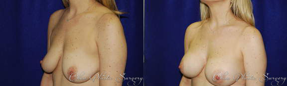 Breast Augmentation Before & After Photo. Breast Augmentation performed at Chau Plastic Surgery in Metro Detroit, MI.