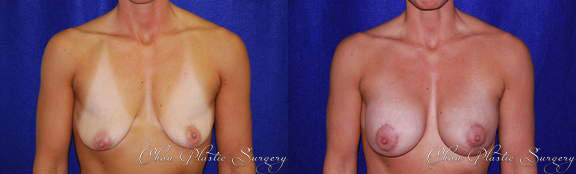Breast Augmentation Before & After Photo. Breast Augmentation performed at Chau Plastic Surgery in Metro Detroit, MI.