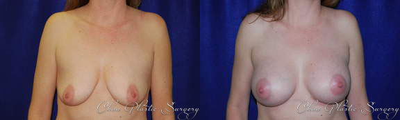 Breast Augmentation Before & After Photo. Breast Augmentation performed at Chau Plastic Surgery in Metro Detroit, MI.